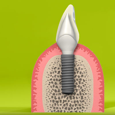 импланты на передние зубы