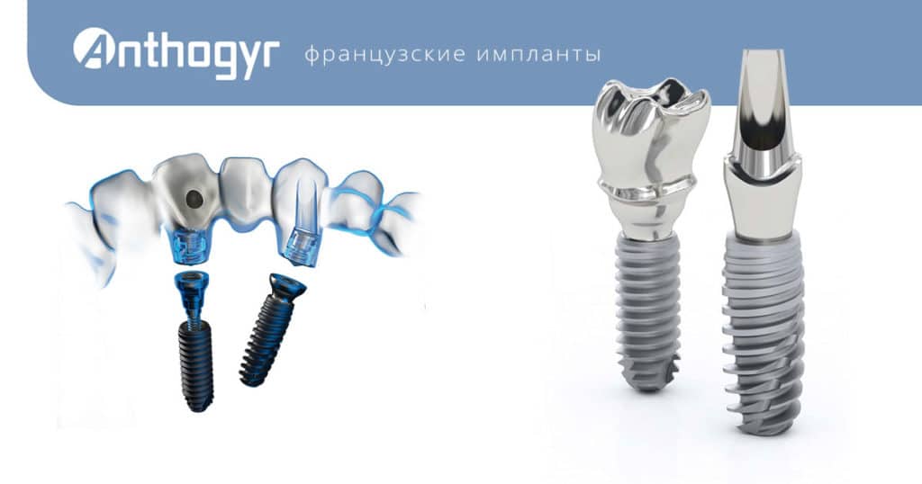 имплантация зубов под ключ Anthogyr