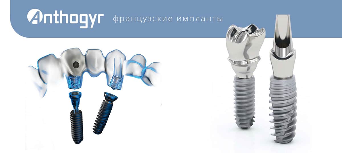 Импланты Anthogyr Томск Залоговая стоматология томск на иркутском тракте цена