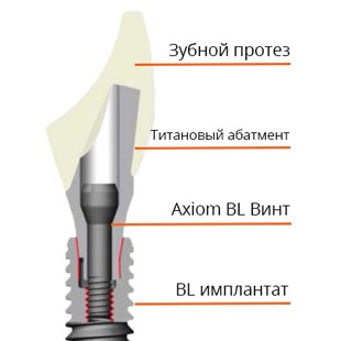 какие импланты лучше ставить на передние зубы?