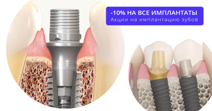 имплантация зубов в москве акции под ключ