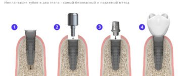 двухэтапная имплантация или классическая имплантация зубов