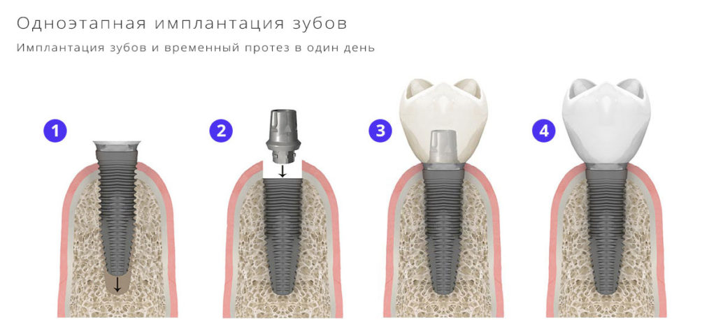 одноэтапная имплантация зубов за 1 день