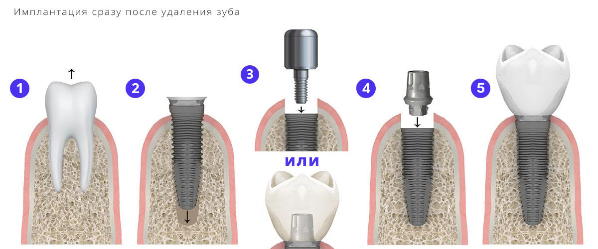 одномоментная имплантация зубов в москве цены отзывы