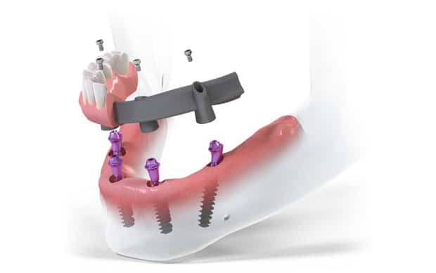 имплантация зубов под ключ All-on-4