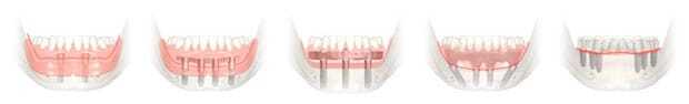 лучший варианты Полная имплантация при полном отсутствии зубов