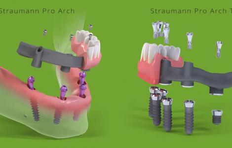 Straumann Pro Arch имплантация всей челюсти