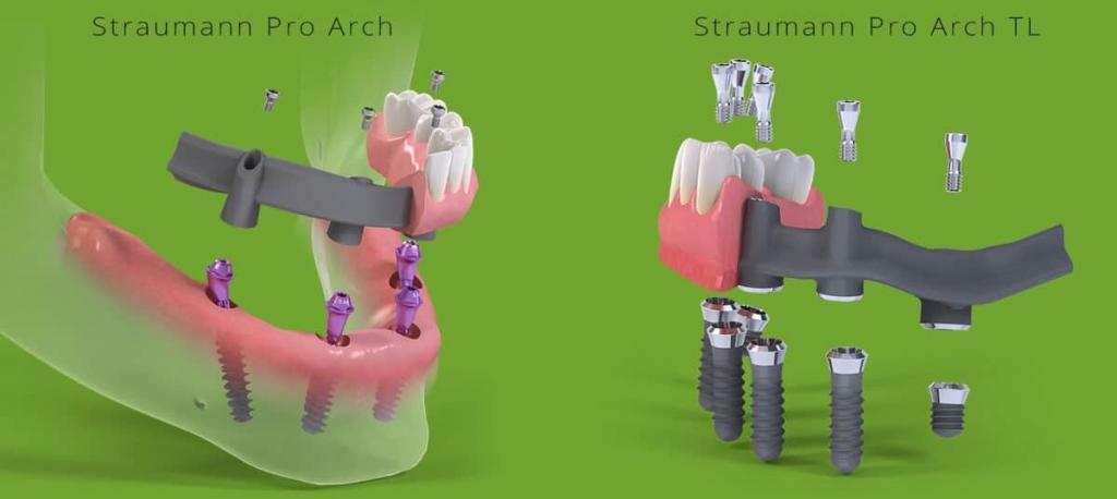 Straumann Pro Arch имплантация всей челюсти