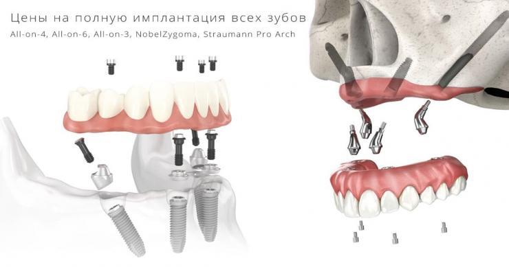 полная имплантация зубов цена