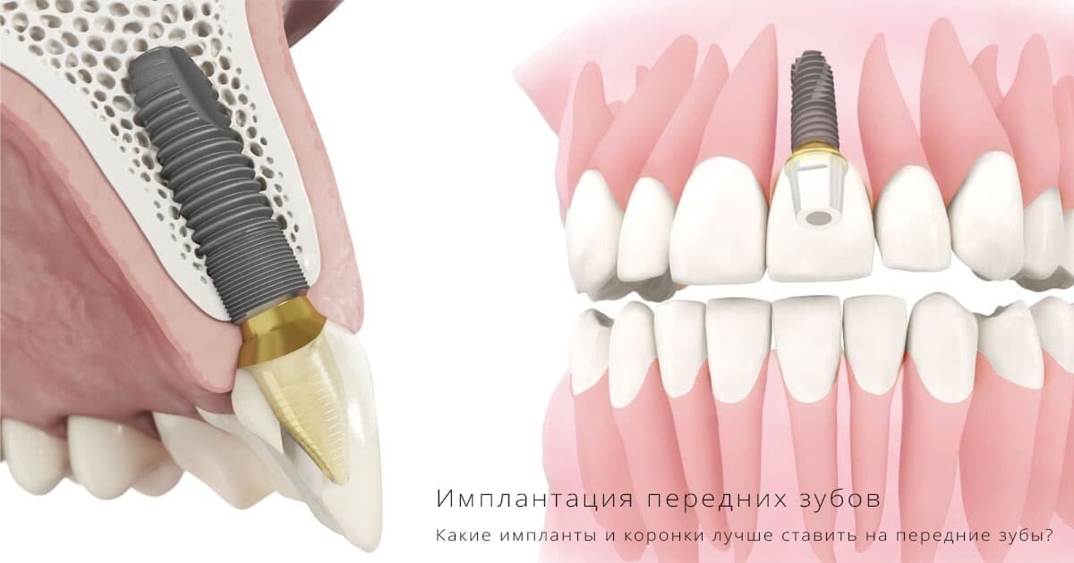 Имплантация зубов — цены и отзывы на установку имплантов