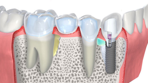 мост или имплант на жевательный зуб