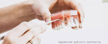 удаление импланта зуба