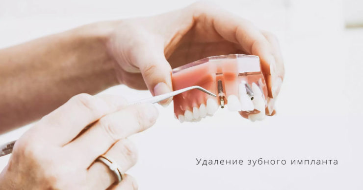 удаление импланта зуба