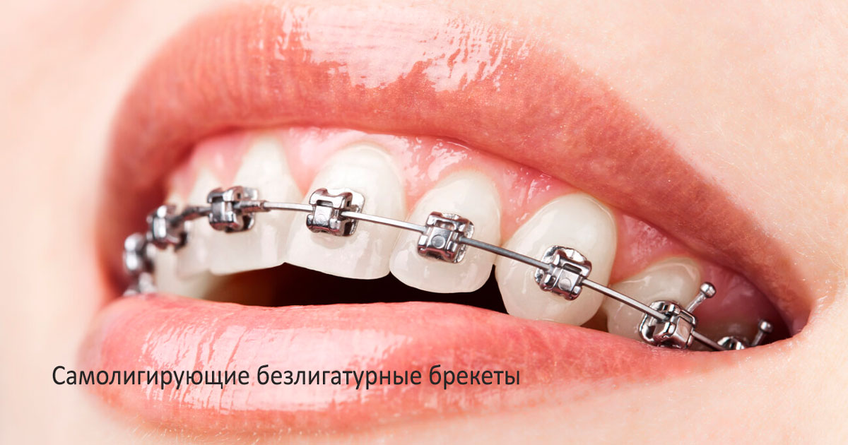 Самолигирующие брекеты Томск Офицерский электронная регистратура томск запись к врачу детская стоматология на ленина