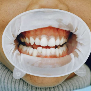 Лечение гингивита в стоматологии