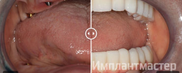 Афонина Алла Стефановна до и после стоматологического лечения