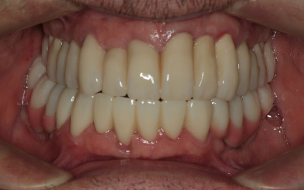 Мужчина после стоматологического лечения 2