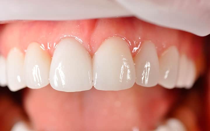 Люминиры на зубы ключевые характеристики