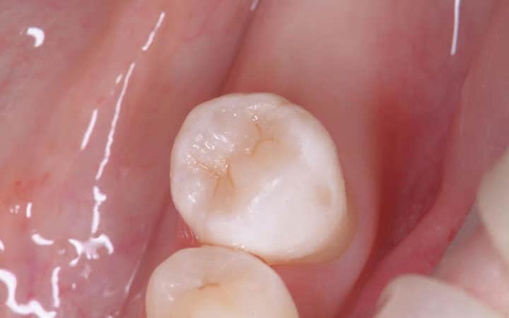 Лечение вторичного и скрытого кариеса жевательного зуба после 2