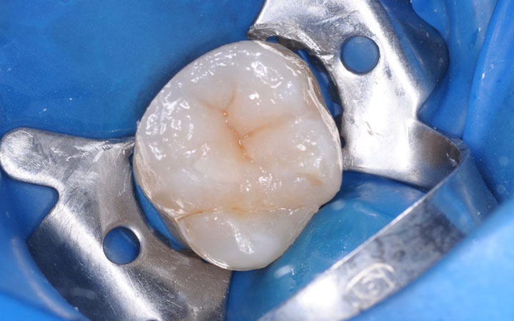 Лечение вторичного и скрытого кариеса жевательного зуба после 3