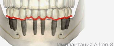 Имплантация All on 8 Все зубы на 8 и имплантах баннер фб