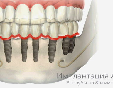 Имплантация All on 8 Все зубы на 8 и имплантах баннер фб