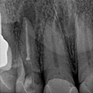 лечение каналов зуба под микроскопом