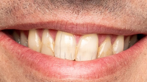 Что характеризует трещины на зубах?