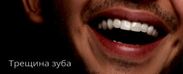 трещины на зубах или трещина зуба