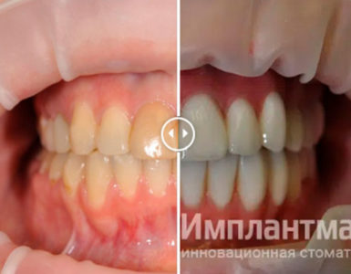 Голливудская улыбка под ключ в лучшей клинике в Москве! до после