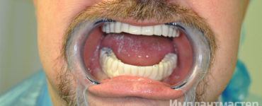 Мастерское протезирование при полном отсутствии всех зубов в стоматологии