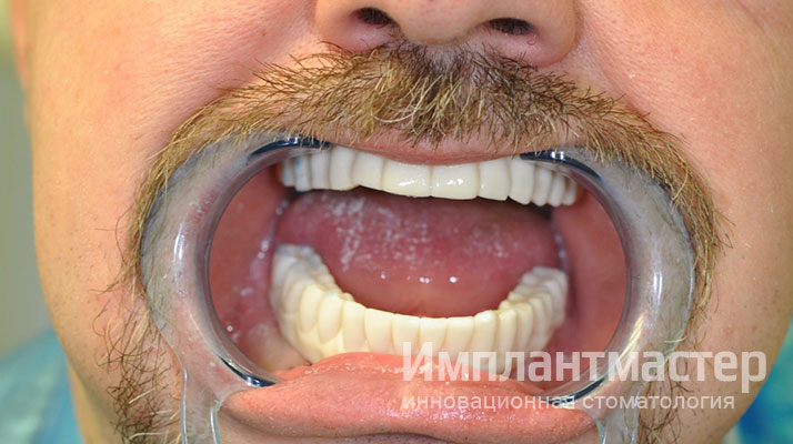 Мастерское протезирование при полном отсутствии всех зубов в стоматологии «Имплантмастер»