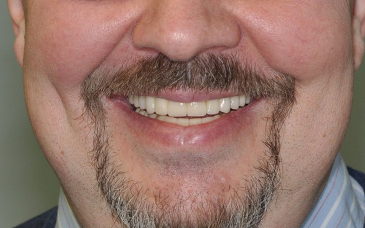 Мастерское протезирование при полном отсутствии всех зубов в стоматологии «Имплантмастер» после
