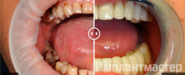 Стираемость и разрушение зубов не проблема для «Имплантмастер»