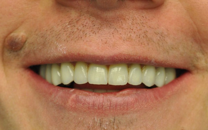 Стираемость и разрушение зубов не проблема для «Имплантмастер» после 2