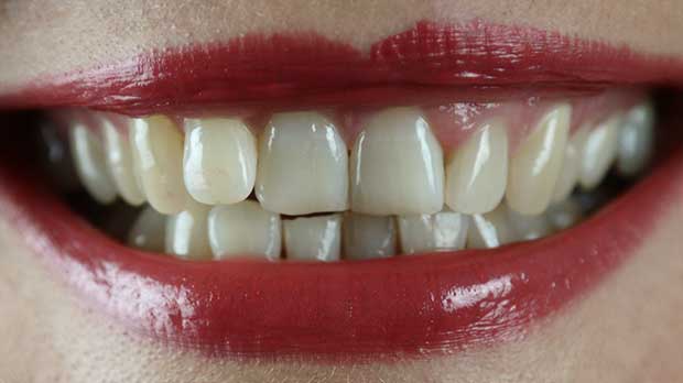 Какое бывает смещение зубов во типу и виду?