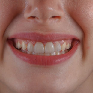 Ключевые характеристики патологии стираемость зубов
