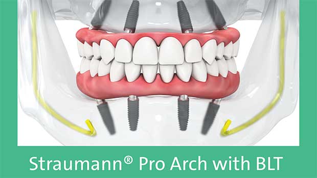 Straumann Pro Arch Имплантация All-on-4 Решение при полной адентии
