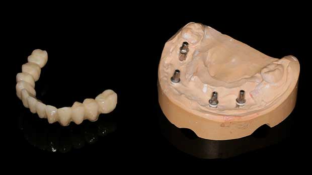 все на четырех имплантах замена протезам Силиконовые зубные протезы