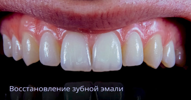 Восстановление зубной эмали