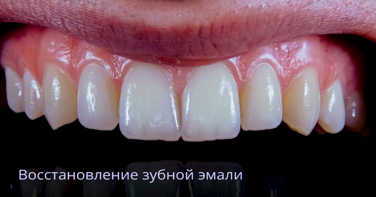 Как восстановить эмаль зуба - Статьи