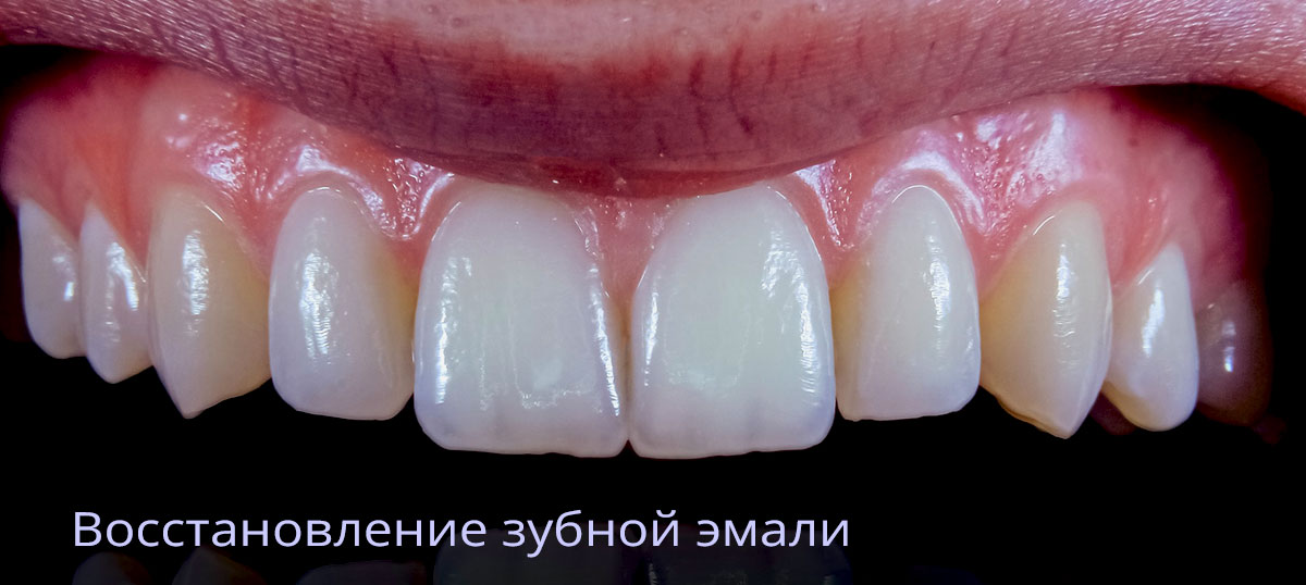 Как укрепить эмаль зубов
