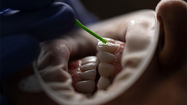 Что такое реминерализация эмали зубов в стоматологии?