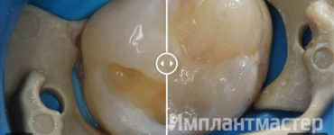 Лечение глубокого кариеса зуба в лучшей стоматологии в Москве