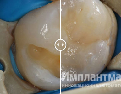 Лечение глубокого кариеса зуба в лучшей стоматологии в Москве