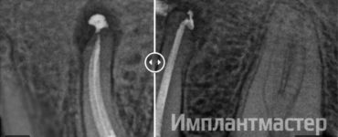 Первичное эндодонтическое кисты в стоматологии в Москве