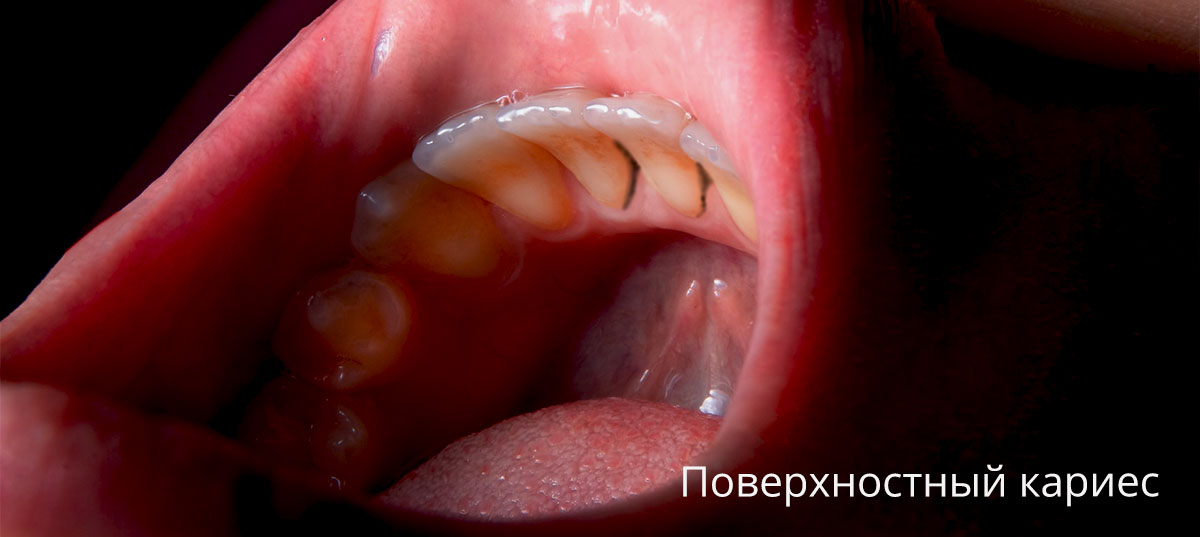 Лечение кариеса временных зубов - детская стоматология М-Дентал