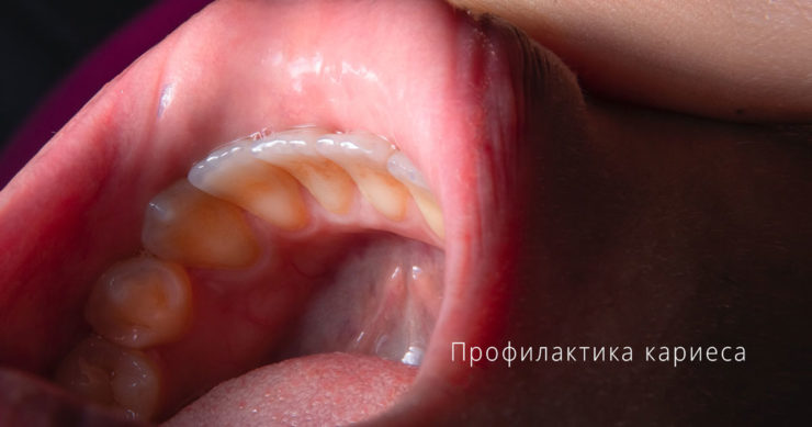 Профилактика кариеса в стоматологии в Москве