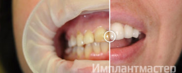Фото, до, после, пример работ, как выглядит винир, восстановить зубы. Эстетическая резервация дефекта передних зубов винирами Е-Мах в лучший стоматологии Москвы. Работы до после.
