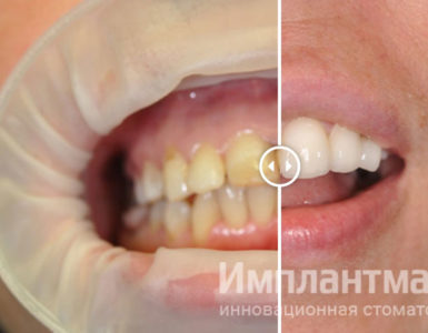 Фото, до, после, пример работ, как выглядит винир, восстановить зубы. Эстетическая резервация дефекта передних зубов винирами Е-Мах в лучший стоматологии Москвы. Работы до после.